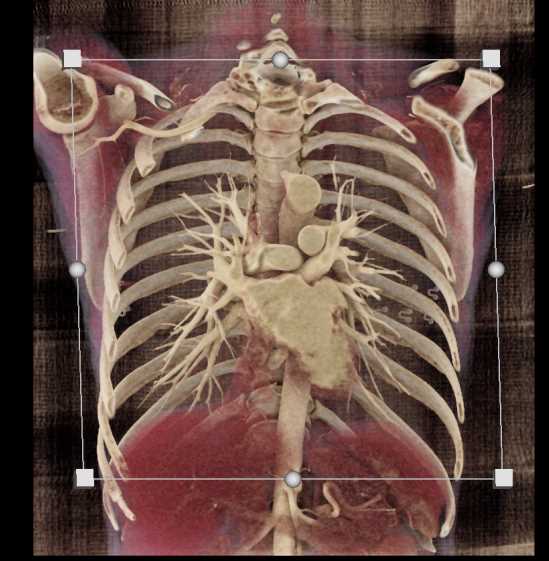 Pulmonary Artery Stenosis - CTisus CT Scan