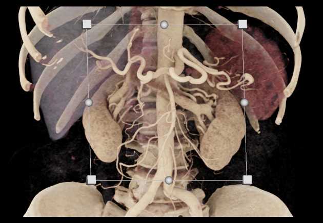 CTA with Encase GDA - CTisus CT Scan