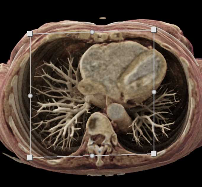 Vascular Mapping with Prominent GDA - CTisus CT Scan