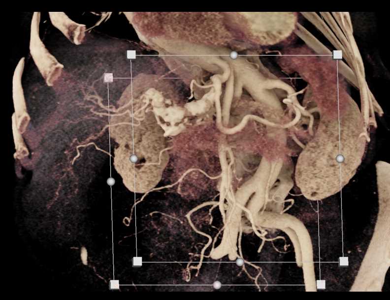 Hepatic Artery Aneurym - CTisus CT Scan