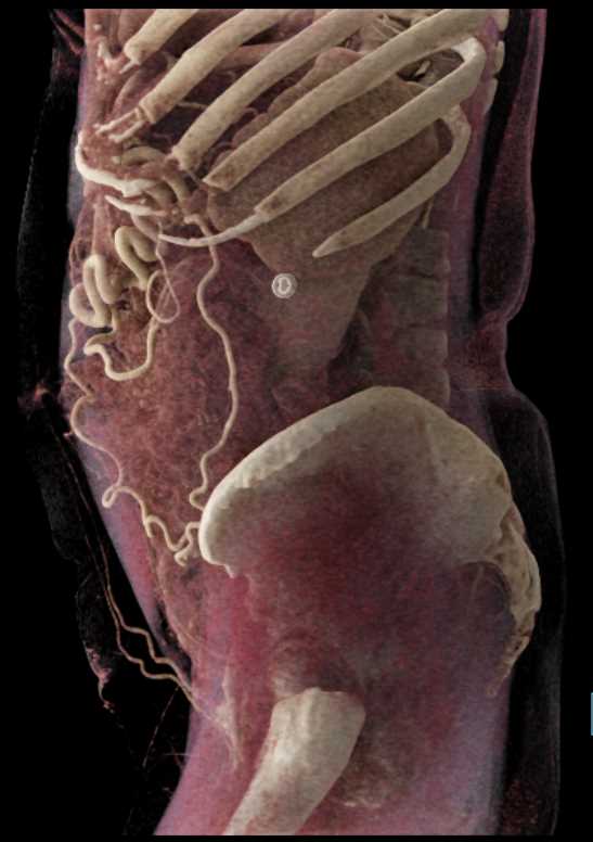 Extensive Collateral Mesenteric Vessels - CTisus CT Scan