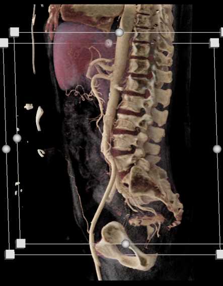 Moderate Plaque Aorta and Iliac Arteries - CTisus CT Scan
