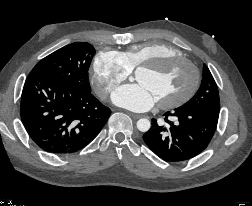 CTisus CT Scanning | Aortic Valve Repair