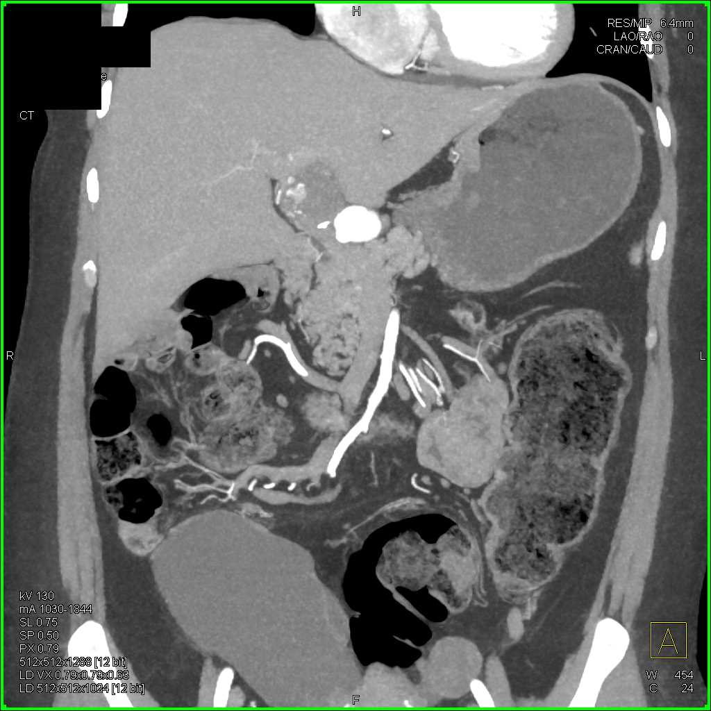 Hepatic Artery Aneurysm - CTisus CT Scan