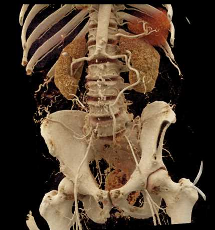 Occlusion of the Abdominal Aorta Beneath the Renal Arteries - CTisus CT Scan