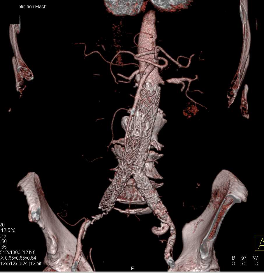 Pulmonary Emboli and Clot in Aorta - CTisus CT Scan