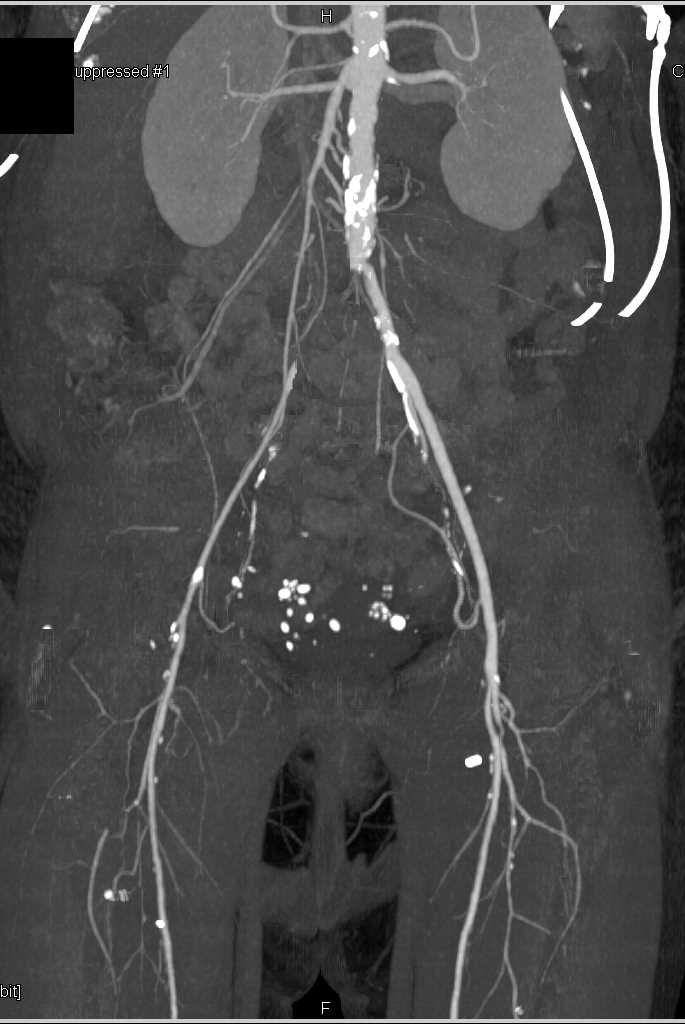 Occlusion Right Common Iliac Artery - CTisus CT Scan