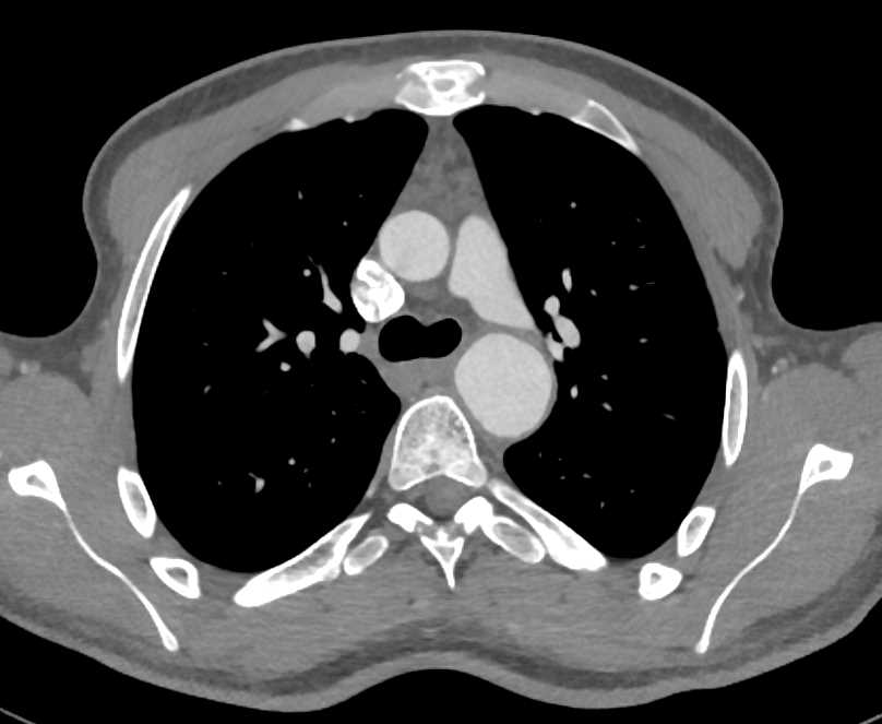 Coarctation of the Aorta - CTisus CT Scan