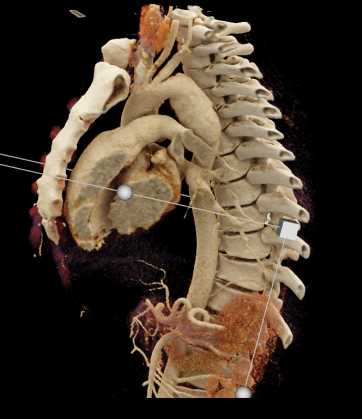 Coarctation of the Aorta - CTisus CT Scan