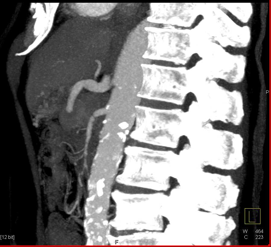 Vasculitis Involves the Superior Mesenteric Artery (SMA) - CTisus CT Scan