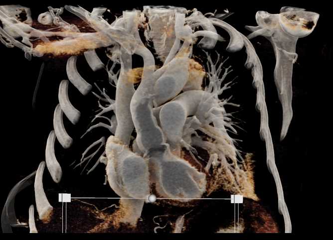 Aortic Root Repair - CTisus CT Scan