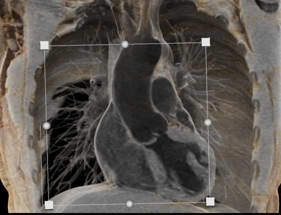 Bicuspid Aortic Valve - CTisus CT Scan