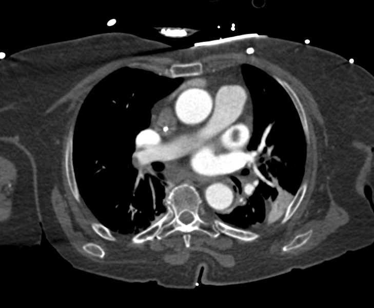Occlusion of the Abdominal Aorta with Additional Thrombus - CTisus CT Scan