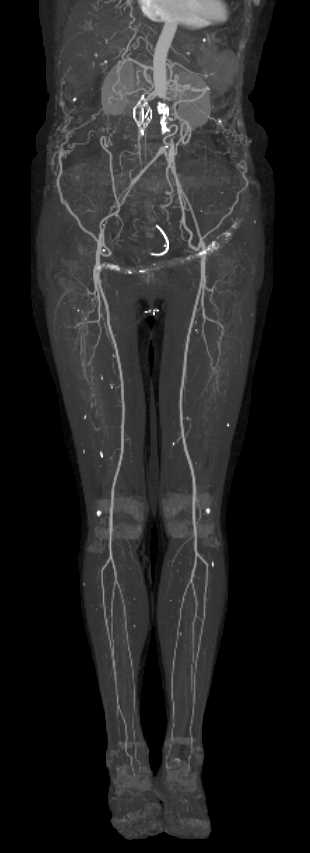 Aortic Occlusion with Collateral Flow - CTisus CT Scan