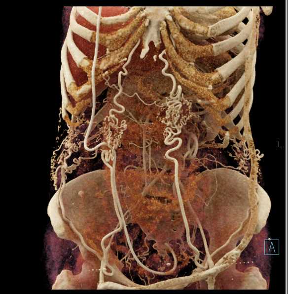 Aortic Occlusion with Extensive Collaterals - CTisus CT Scan