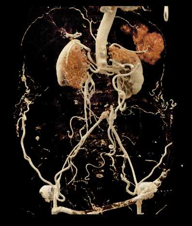 Aortic Occlusion with Extensive Collaterals - CTisus CT Scan