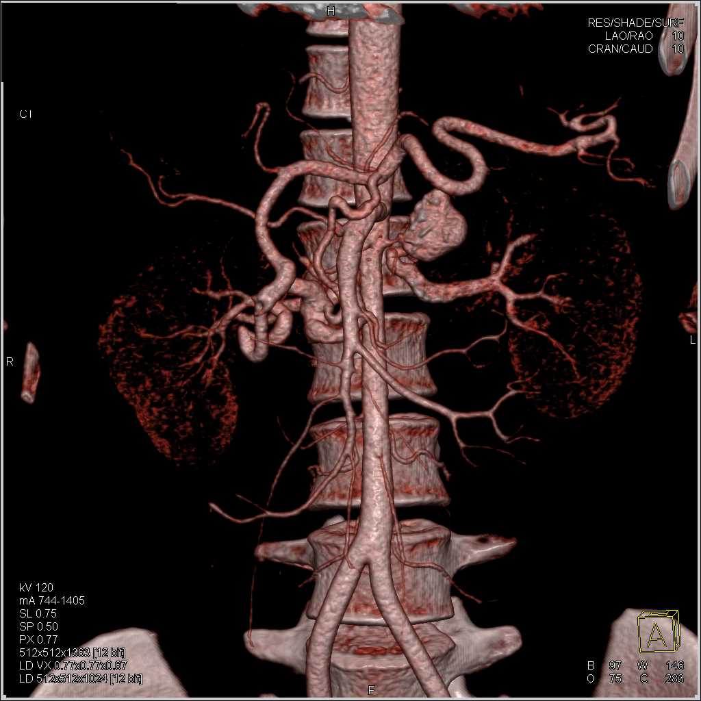 Pseudoaneurysm off the Aorta - CTisus CT Scan