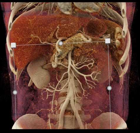 Pseudoaneurysm off the Aorta - CTisus CT Scan