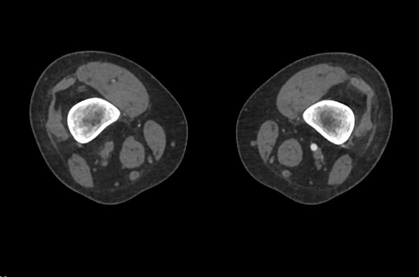 Occluded Popliteal Artery - CTisus CT Scan