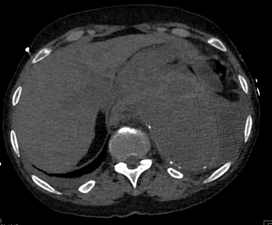 Large Aortic Aneurysm with Turbulent Flow - CTisus CT Scan