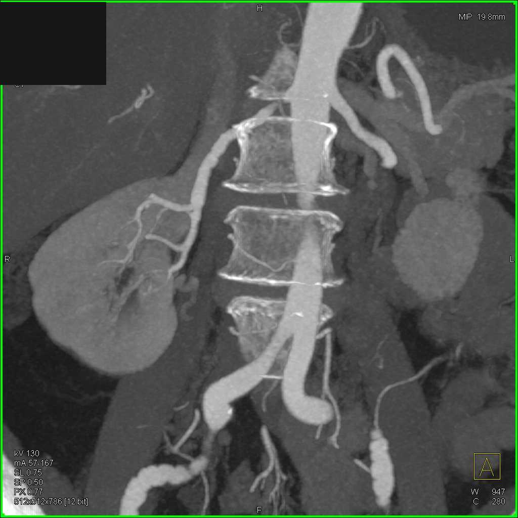Fibromuscular Dysplasia (FMD) Right Renal Artery and Iliac Arteries - CTisus CT Scan