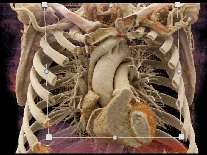 Endovascular Stent Repair with CR Display - CTisus CT Scan