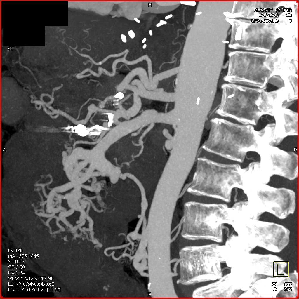 Vasculitis Mesentery - CTisus CT Scan