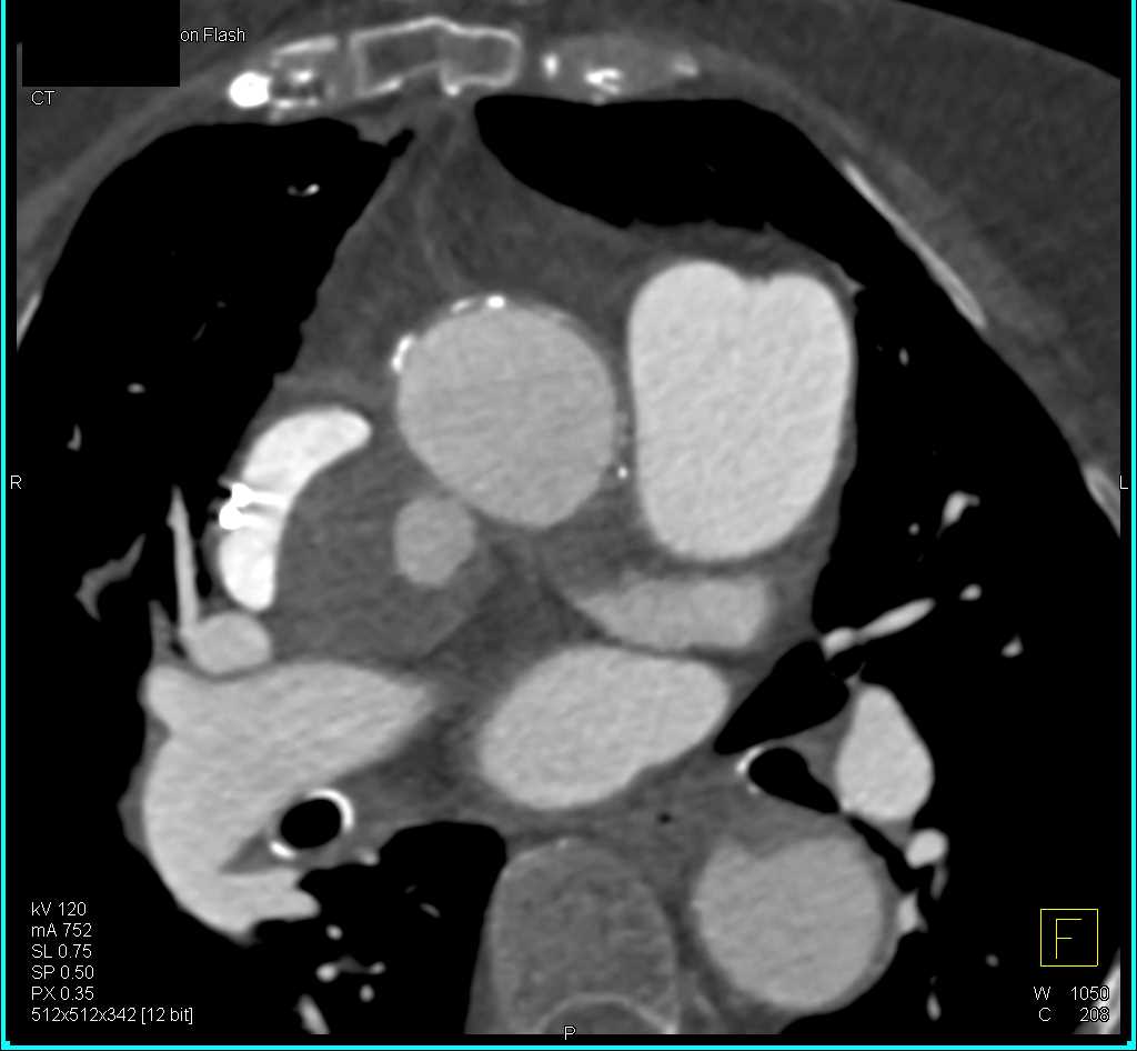 Pseudoaneurym Ascending Aorta - CTisus CT Scan