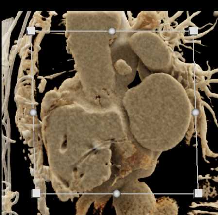 Pseudoaneurym Ascending Aorta - CTisus CT Scan