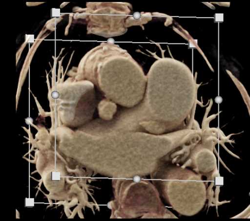 Pseudoaneurym Ascending Aorta with CR - CTisus CT Scan