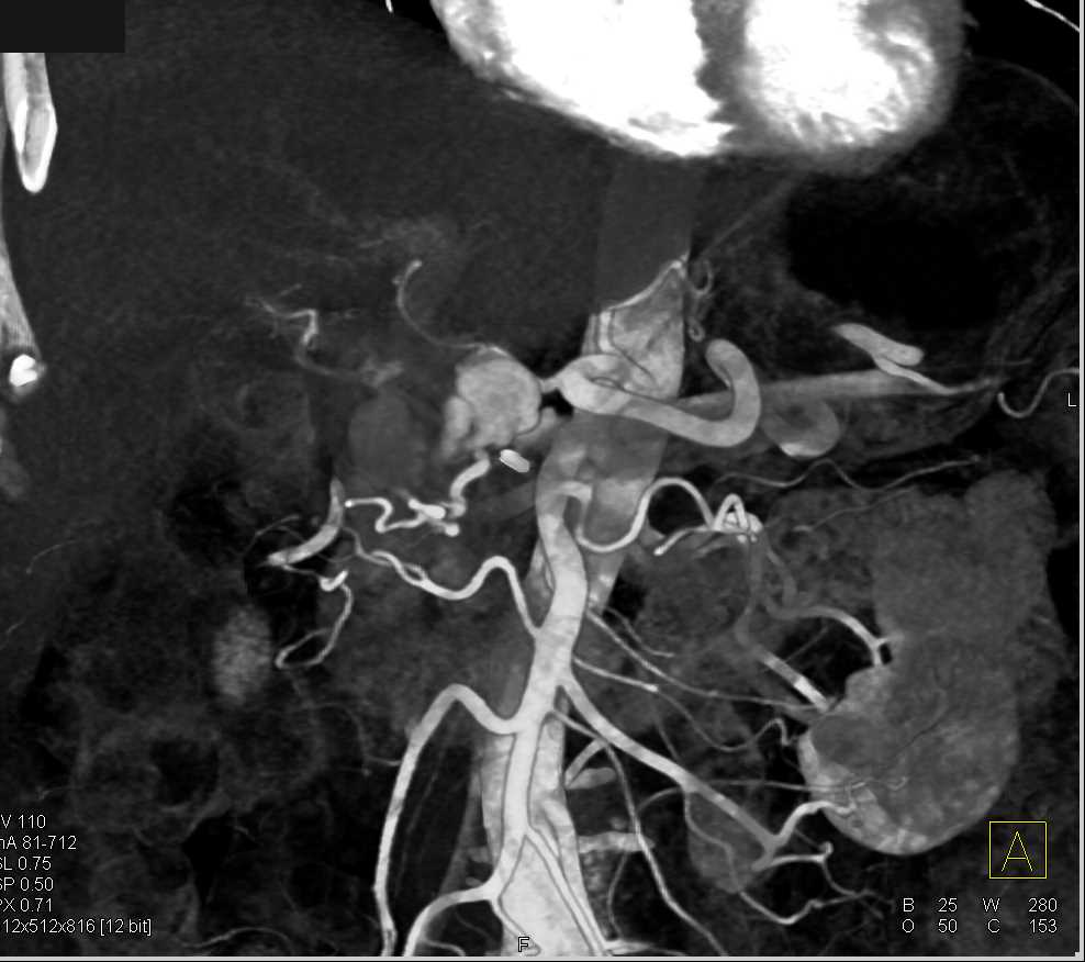 Mesenteric Aneurysms Look Like Renal Artery Aneurysm - CTisus CT Scan