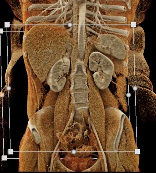 Vasculitis with Mesenteric Vascular Involvement - CTisus CT Scan