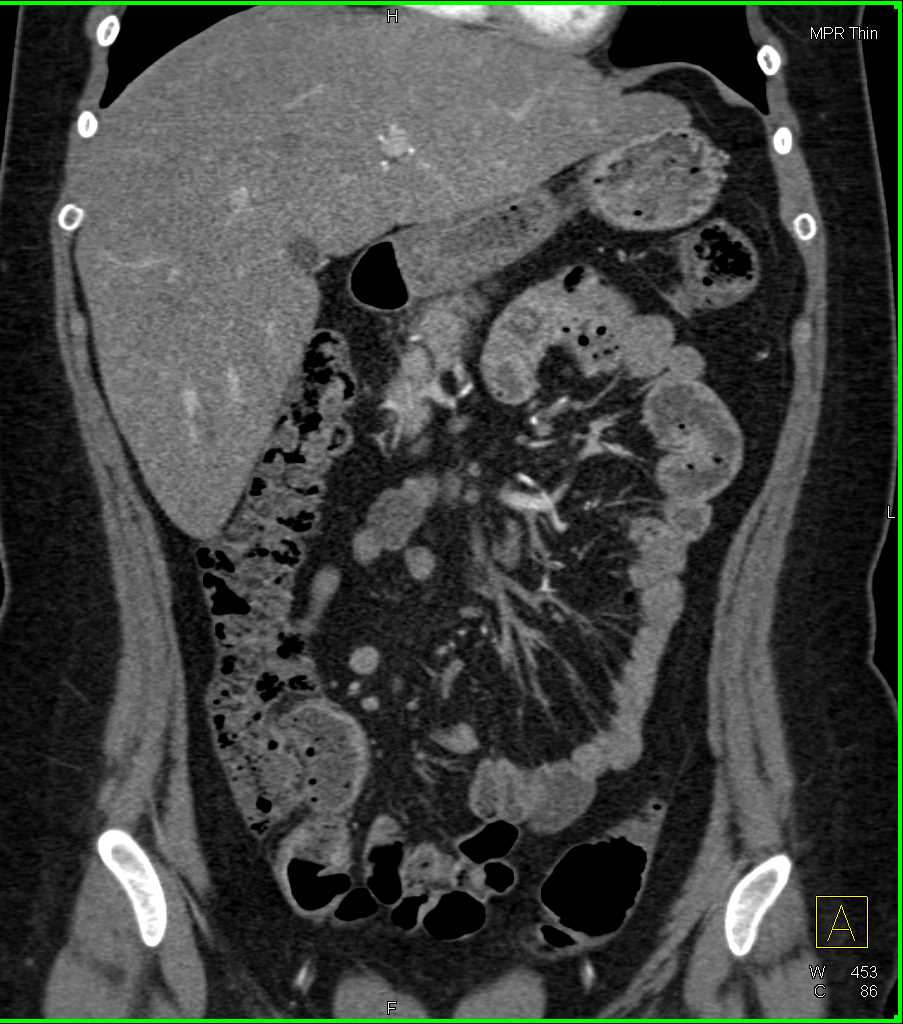 Vasculitis with Mesenteric Vascular Involvement - CTisus CT Scan
