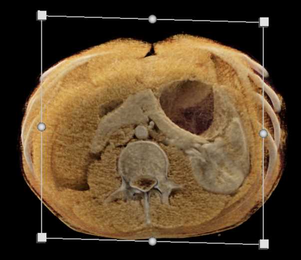 Superior Mesenteric Artery (SMA) Syndrome - CTisus CT Scan