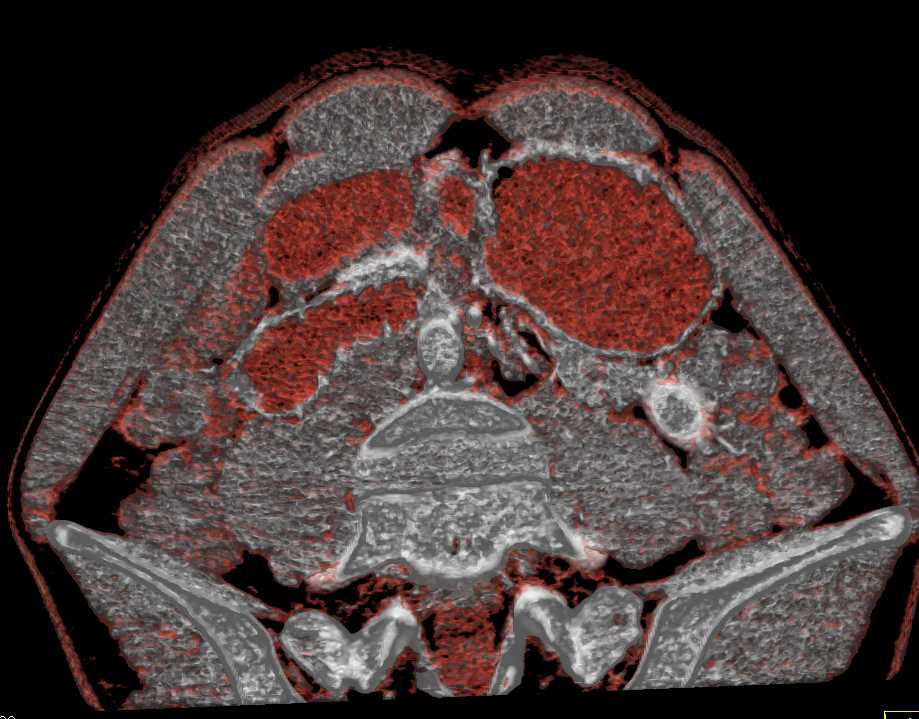 Superior Mesenteric Artery (SMA) Syndrome - CTisus CT Scan