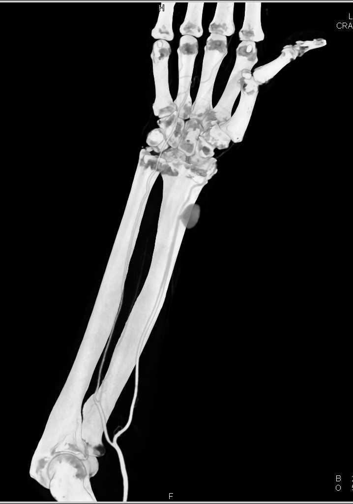 Pseudoaneurysm Radial Artery - CTisus CT Scan