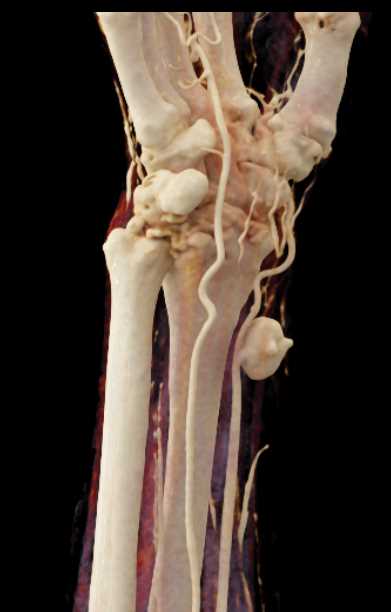 Pseudoaneurysm Radial Artery - CTisus CT Scan