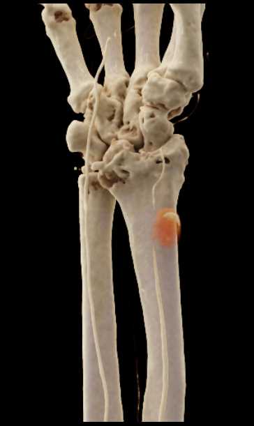 Pseudoaneurysm Radial Artery - CTisus CT Scan