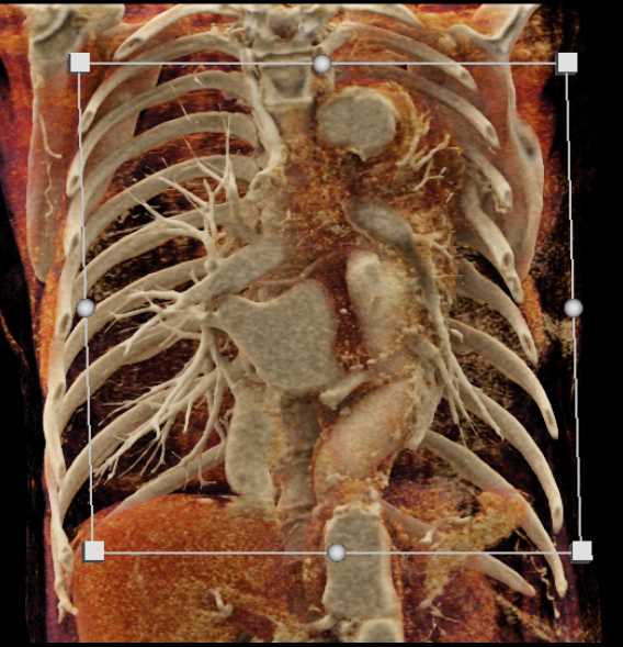 Ulcerating Aneurysm Descending Thoracic Aorta - CTisus CT Scan