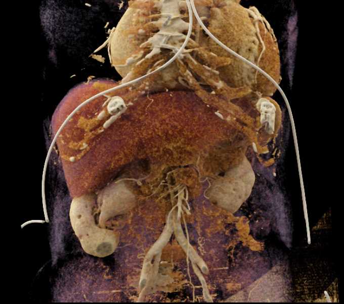 Arteriovenous (AV) Fistulae Right Kidney - CTisus CT Scan