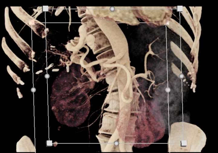 Multiple Gastroduodenal Artery (GDA) Aneurysms - CTisus CT Scan
