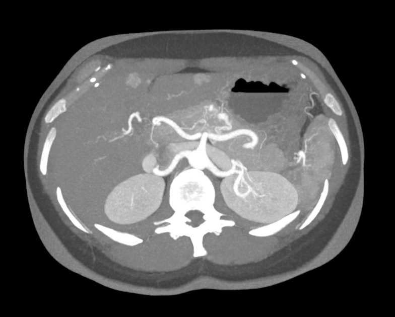 Hereditary Hemorrhagic Telangiectasia (HHT) Disease with AV Shunts in Liver and Pancreas - CTisus CT Scan