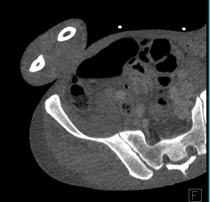 Septic Thrombophlebitis Femoral Vein - CTisus CT Scan