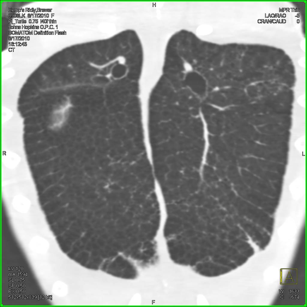 Lungs of a Sea Turtle with Recent Infection - CTisus CT Scan