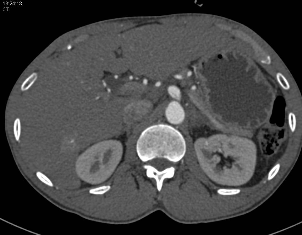 Dissection in the Celiac Artery - CTisus CT Scan