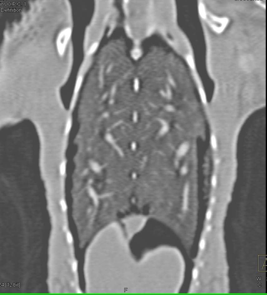 Razorbill with no Site of Infection - CTisus CT Scan