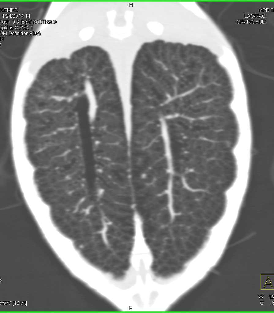 Sea Turtle Without Abnormality - CTisus CT Scan