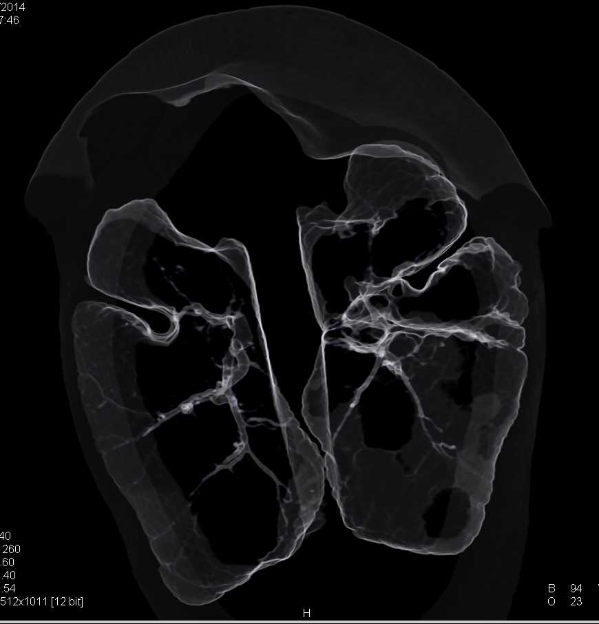 Variant of Lung Parenchyma and Airways in a Turtle - CTisus CT Scan