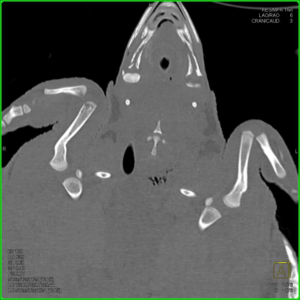 Osteomyelitis Right Humerus in a Turtle - CTisus CT Scan