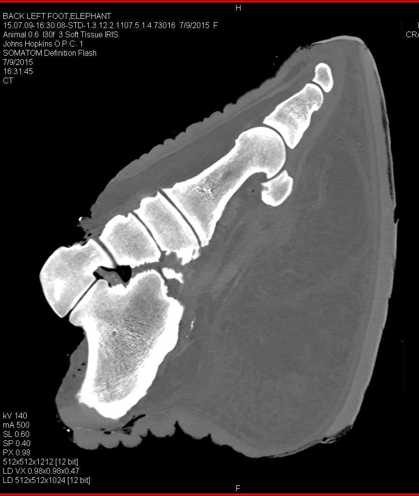 Elephant Foot in 3D - CTisus CT Scan